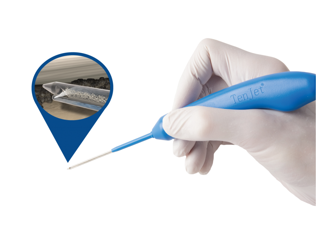 Diagram of the TenJet FluidJet mechanism resecting degenerative tendon tissue